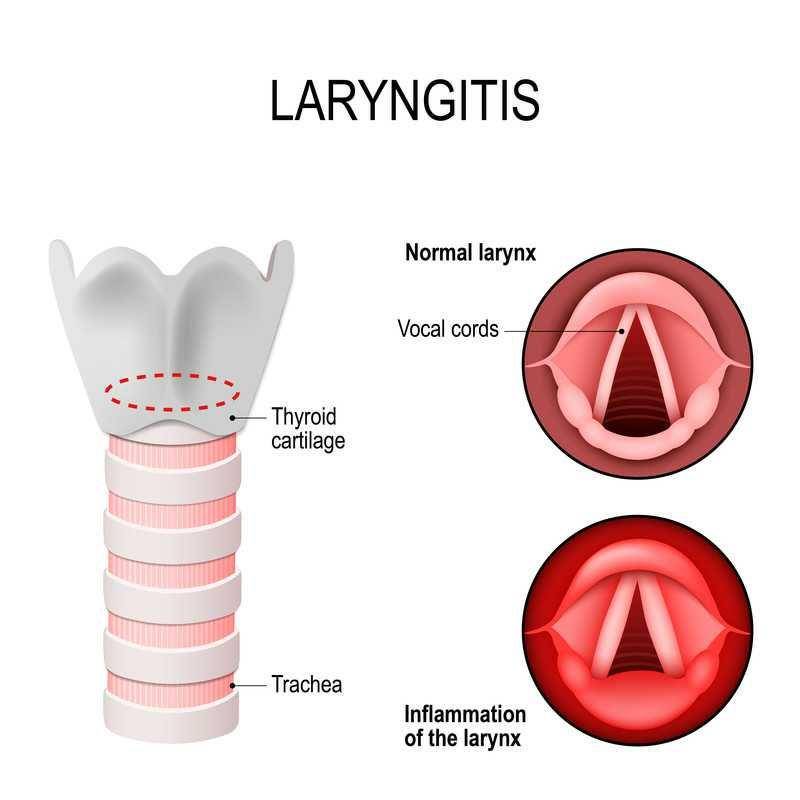 ilustrasi laringitis (health.harvard.edu)
