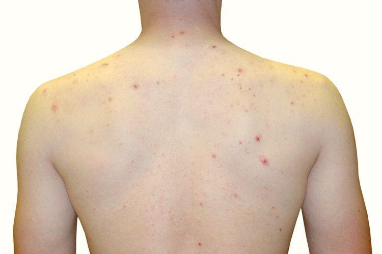 9 Cara Menghilangkan Jerawat di Punggung, Efektif!