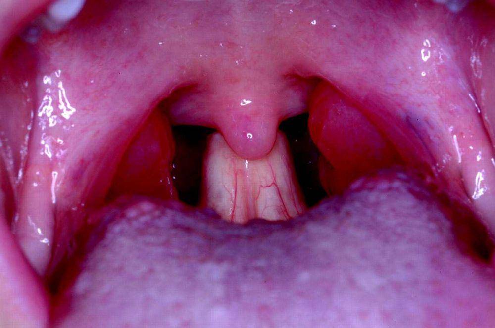ilustrasi epiglotitis (jabfm.org)