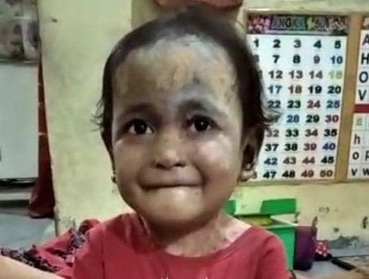 Anak Berpenyakit Kulit Aneh Asal Madina Bertambah, karena Tambang?