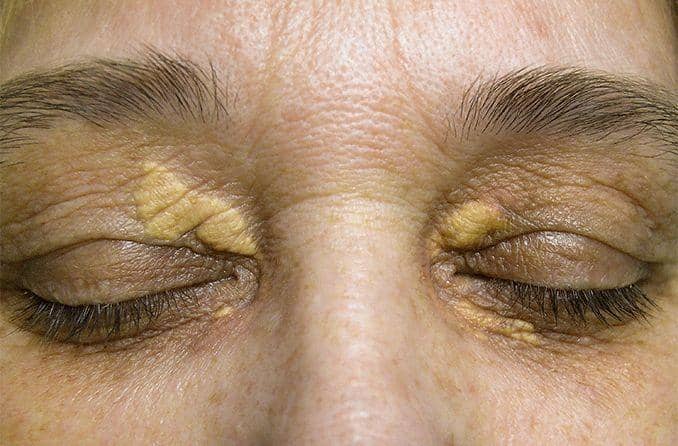 ilustrasi xanthelasma (allaboutvision.com)