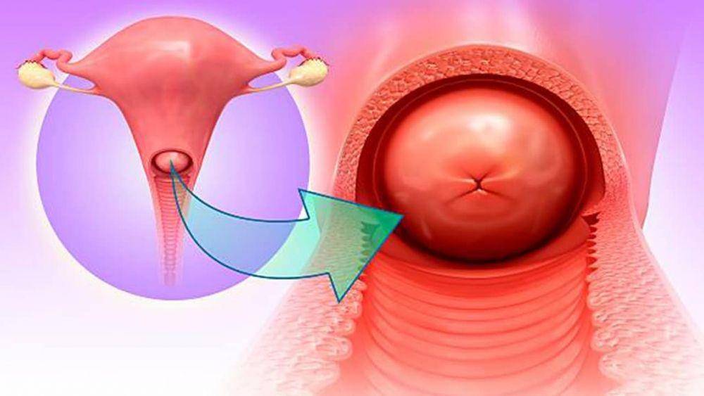 ilustrasi servisitis atau cervicitis (webmd.com)