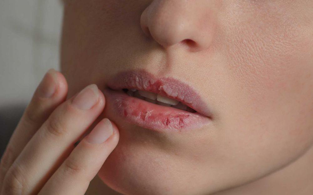 7 Penyebab Utama Mulut dan Bibir Kering, Awas Jangan Dikelupas!