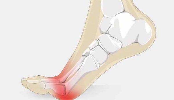ilustrasi nyeri di telapak kaki pada metatarsalgia (runtothefinish.com)