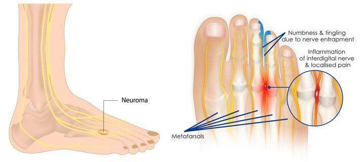 ilustrasi metatarsalgia (vascularhealthclinics.org)