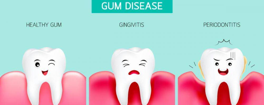 ilustrasi perbandingan gusi sehat, gingivitis, dan periodontitis (westoldsdental.ca)