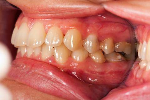 ilustrasi gingivitis atau radang gusi (trustedhealthproducts.com)