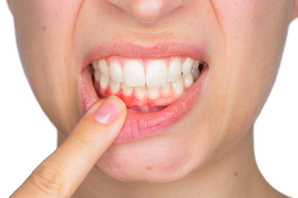 Gingivitis (Radang Gusi): Penyebab, Faktor Risiko, Gejala, Pengobatan