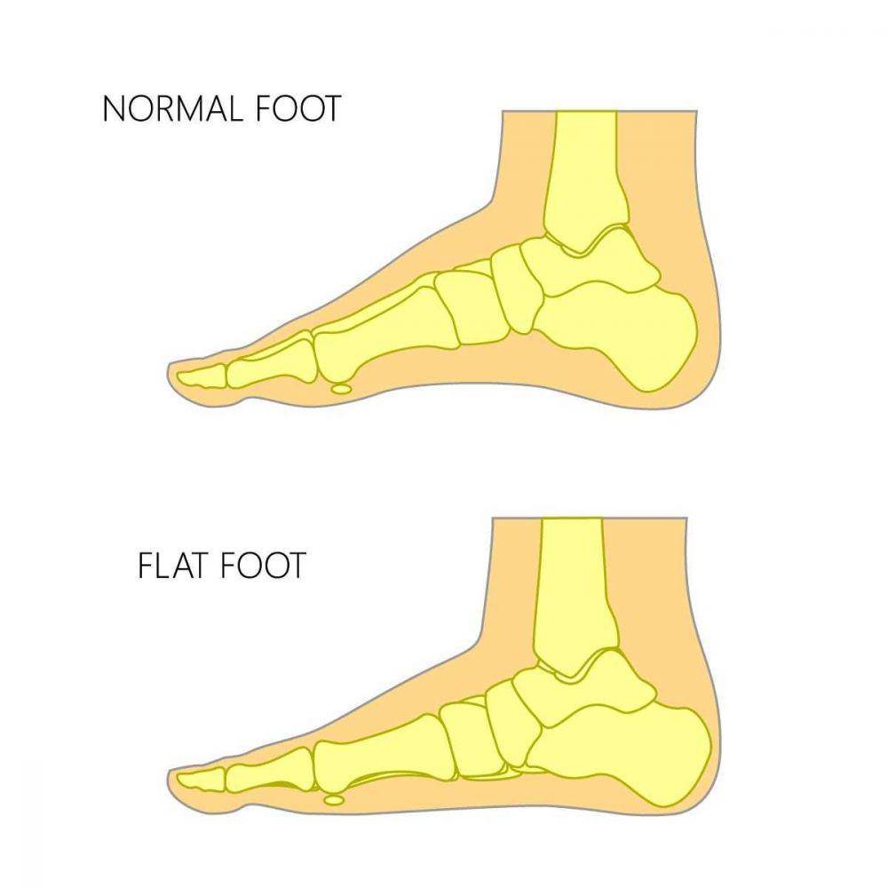 ilustrasi kaki datar atau flat feet (kenkoh.jp)