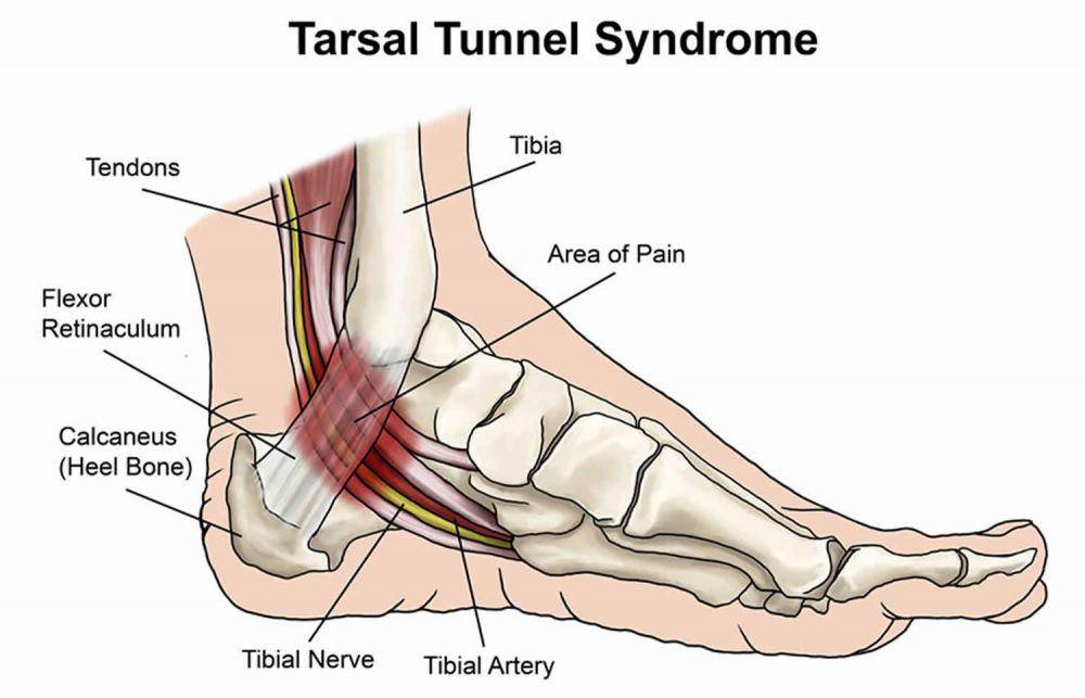 ilustrasi tarsal tunnel syndrome (healthjade.net)