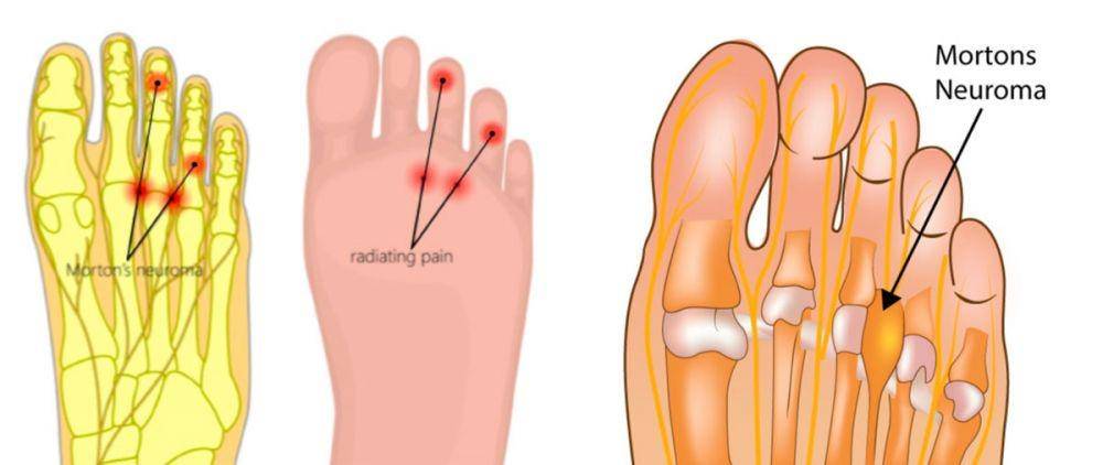 ilustrasi neuroma Morton (danielgoldbloom.com.au)