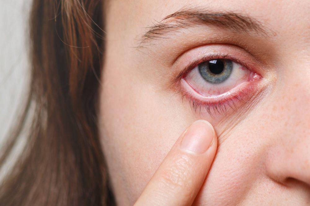 Konjungtivitis Alergi: Penyebab, Gejala, Diagnosis, dan Pengobatan