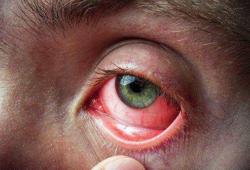ilustrasi konjungtivitis alergi (medicinenet.com)