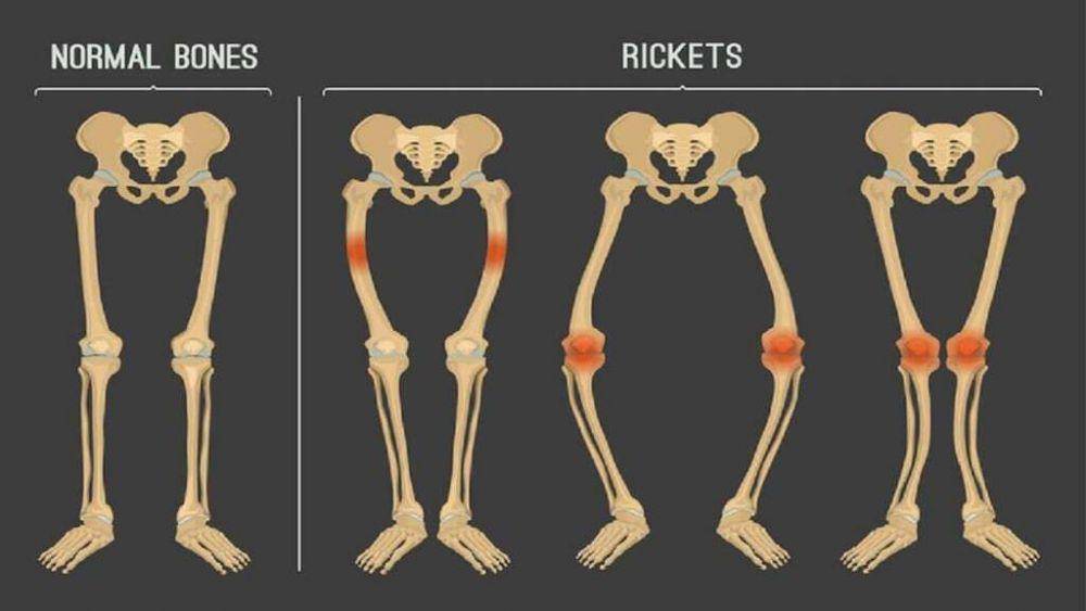 ilustrasi tulang yang mengalami rakhitis (www.medicine.com)