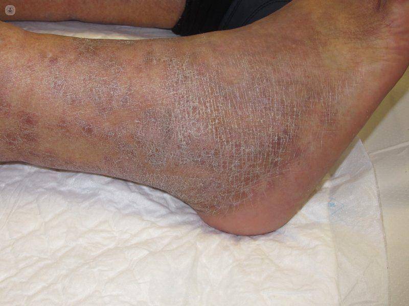 ilustrasi dematitis statis (yourveininstitute.com)