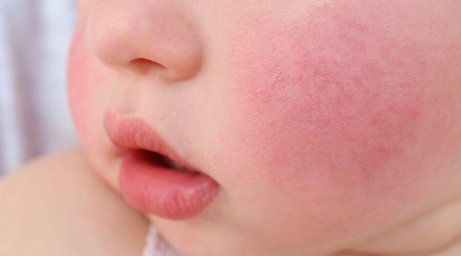 Muncul Ruam di Pipi Anak, Ketahui 5 Fakta seputar Penyakit Kelima