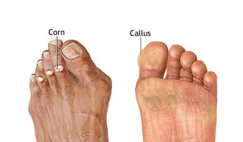 ilustrasi perbedaan kulit kaki jagung (foot corn) dan callus (kapalan) (countryfootcare.com)