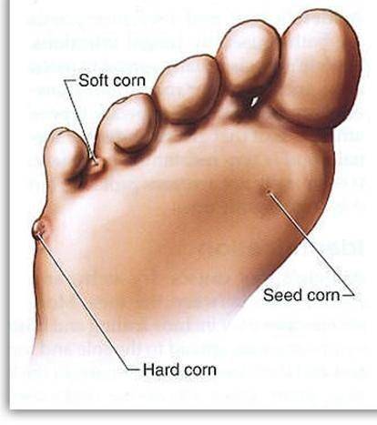 ilustrasi jenis foot corn atau kaki jagung (customfootclinic.com)