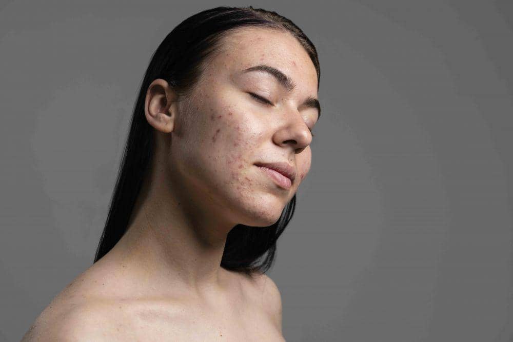 Bukan Hanya Jerawat, Ini 5 Penyebab Munculnya Noda Hitam pada Kulit