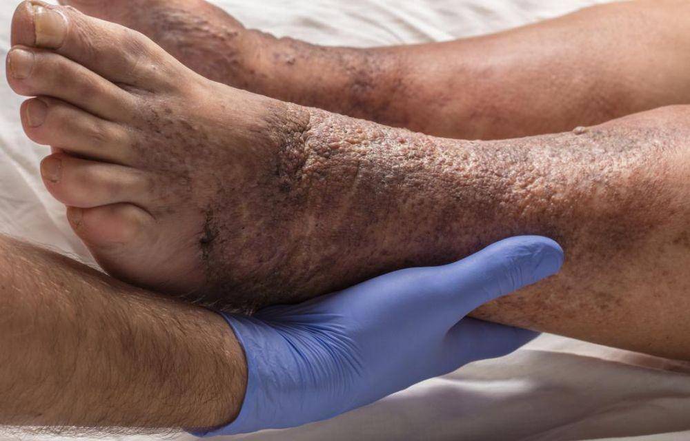 ilustrasi dermatitis stasis yang parah (nationaleczema.org)