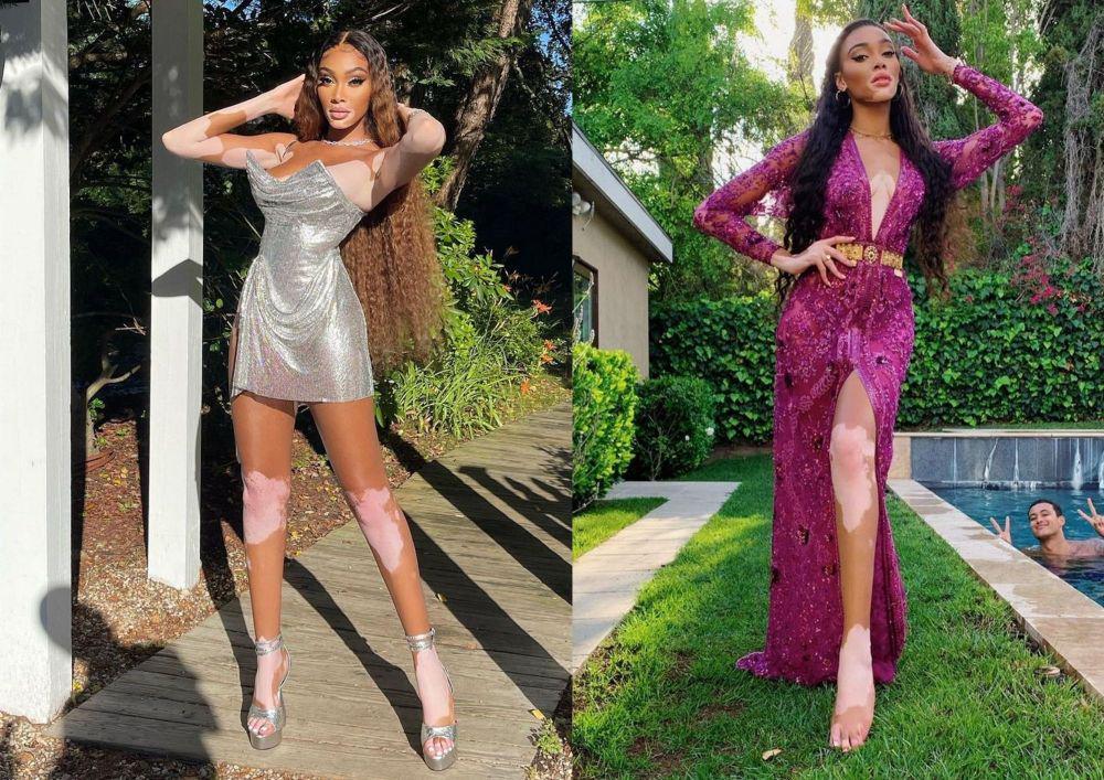 Ulang Tahun ke-26, Ini 9 Fakta Model Winnie Harlow yang Menginspirasi