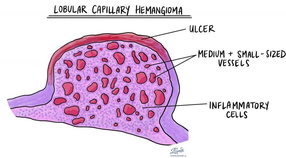 ilustrasi terbentuknya hemangioma (mypathologyreport.ca)