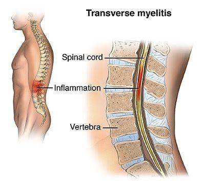 ilustrasi mielitis transversa (hopkinsmedicine.org)