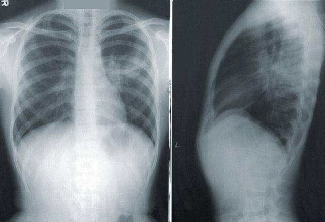 ilustrasi hasil tes x-ray paru-paru manusia (unsplash.com/CDC)