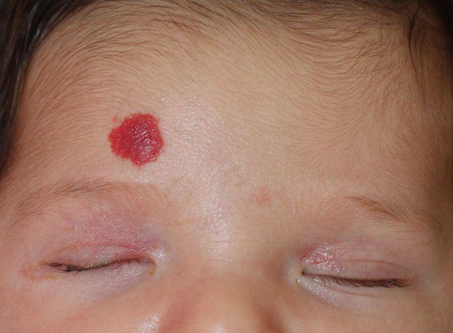 ilustrasi hemangioma pada bayi (ejpd.com/Milano A.)