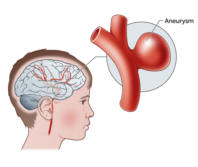 ilustrasi aneurisme otak (rch.org.au)