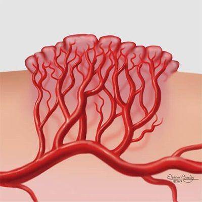 ilustrasi hemangioma (hopkinsmedicine.org/Eleanor Bailey)