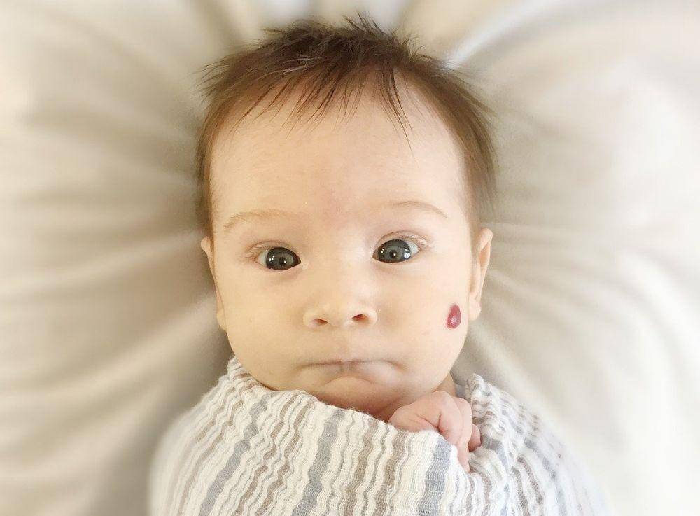 ilustrasi bayi dengan hemangioma (pixabay.com/wendymooney)