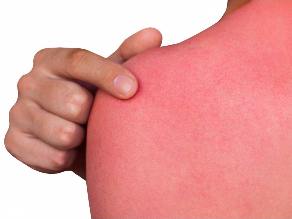 ilustrasi kulit memerah akibat sunburn (cbs19.tv)