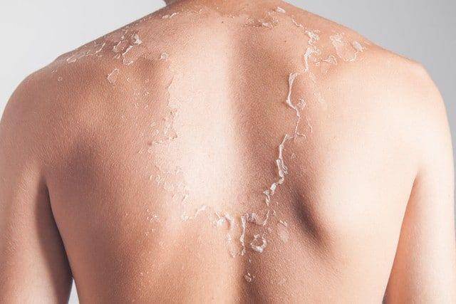 ilustrasi kulit mengelupas (kendalldermatology.com)
