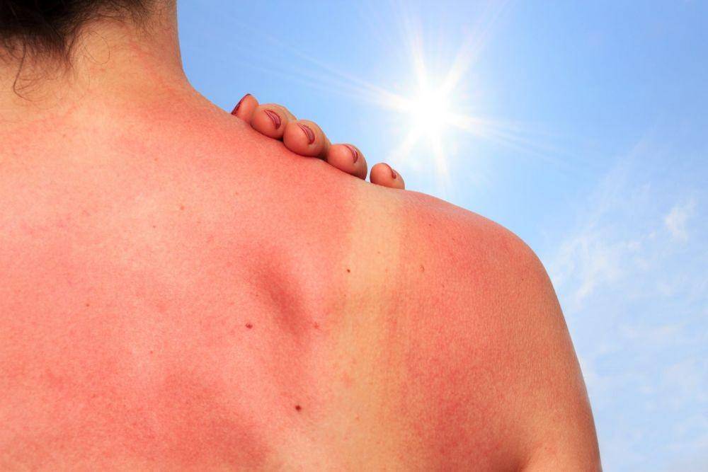 ilustrasi sunburn (mdpremier.com)