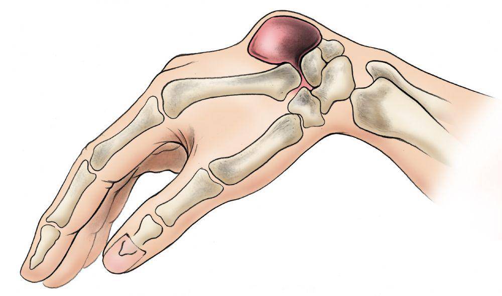 ilustrasi kista ganglion (orthoinfo.aaos.org)