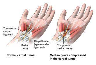 ilustrasi carpal tunnel syndrome (hopkinsmedicine.org)