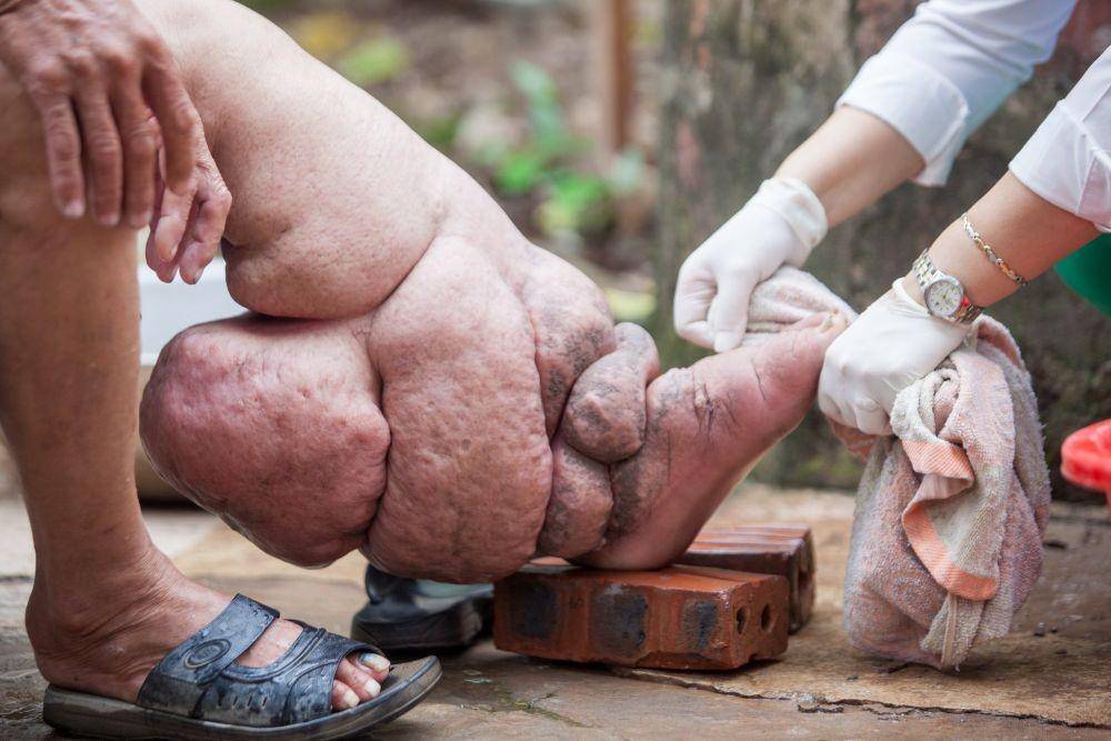 ilustrasi kaki gajah atau filariasis limfatik (globalcitizen.org)