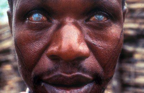ilustrasi penyakit river blindness (sanger.ac.uk)