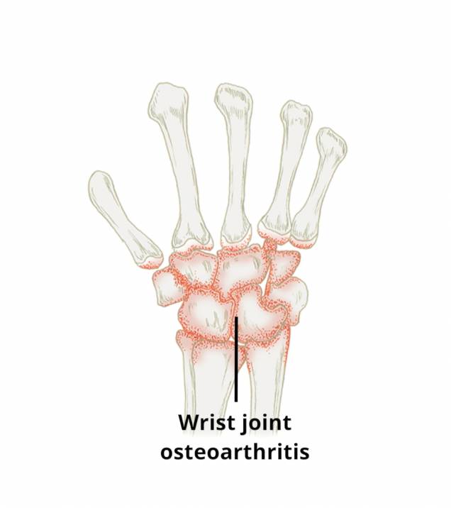 ilustrasi osteoartritis di pergelangan tangan (circlehealth.co.uk)
