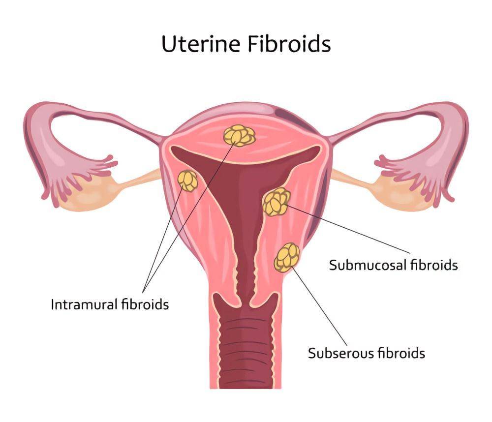 ilustrasi fibroid (astralaparoscopy.com)