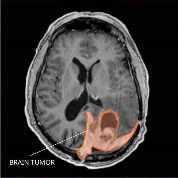 ilustrasi meningioma (cancer.gov)