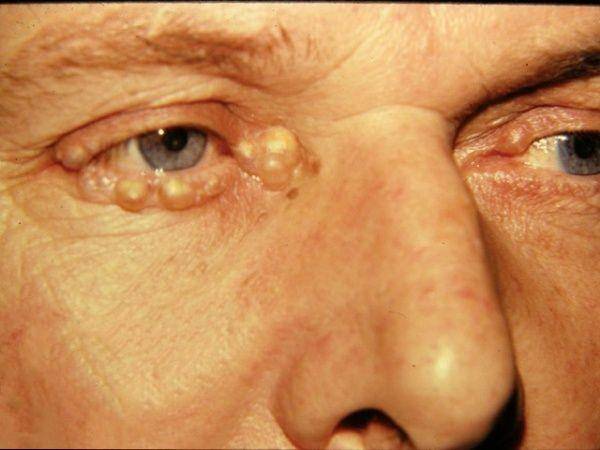 ilustrasi xantelesma atau xanthelasma (dermnetnz.org)