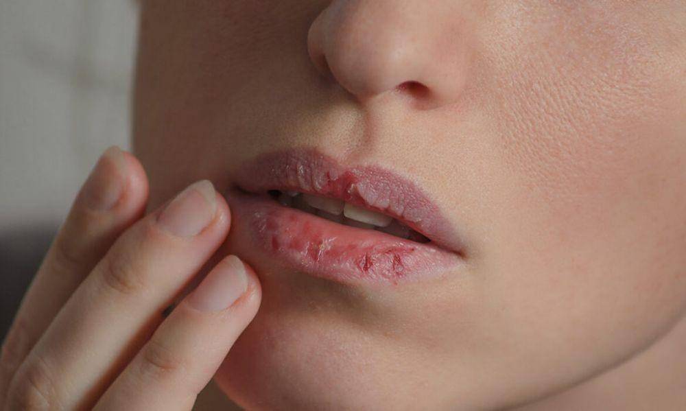 ilustrasi bibir kering (lipaniskincare.com)