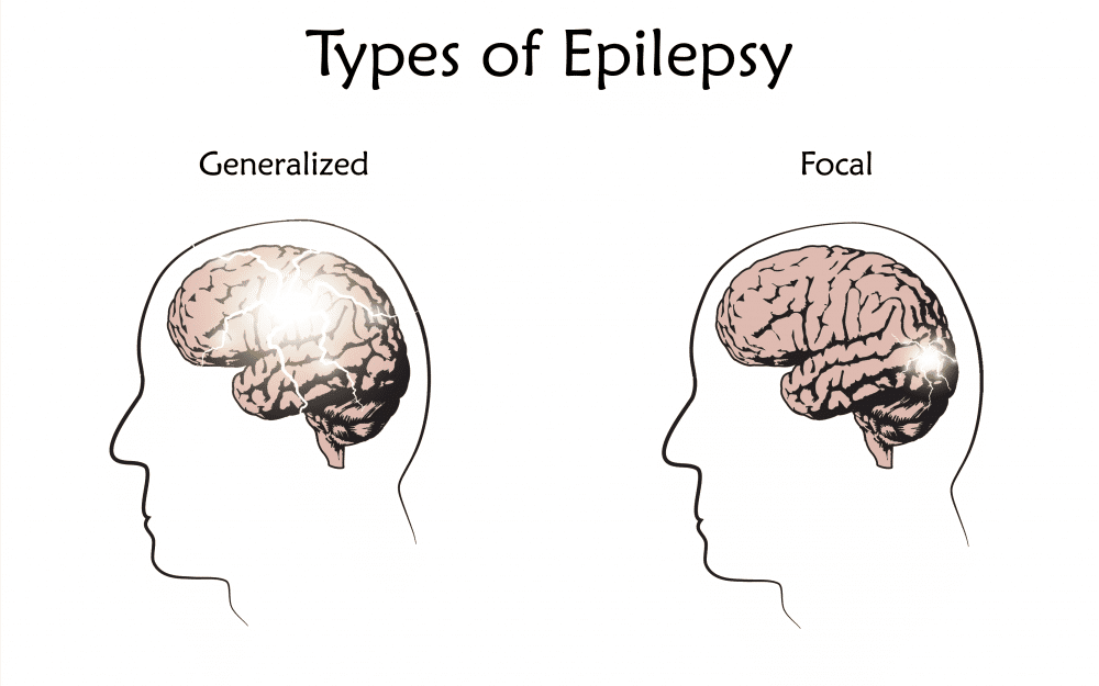 ilustrasi jenis epilepsi (epilepsyqueensland.com.au)