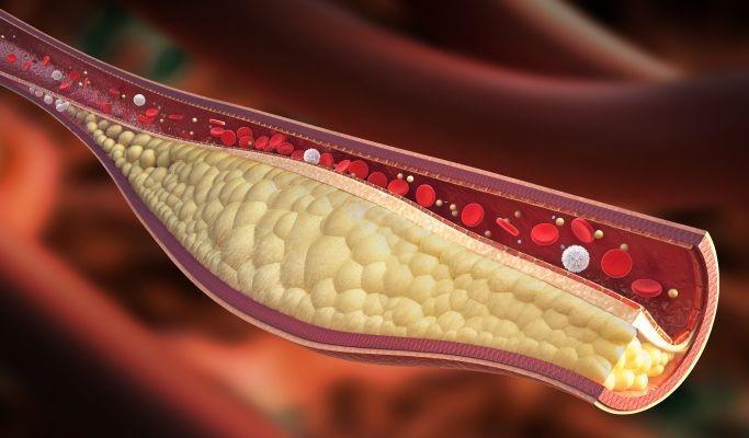 Dislipidemia, Faktor Risiko Penyakit Jantung Koroner dan Stroke