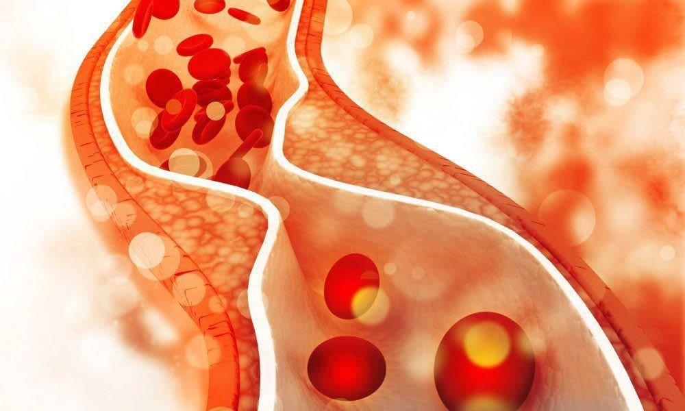 ilustrasi dislipidemia (diabetes.co.uk)