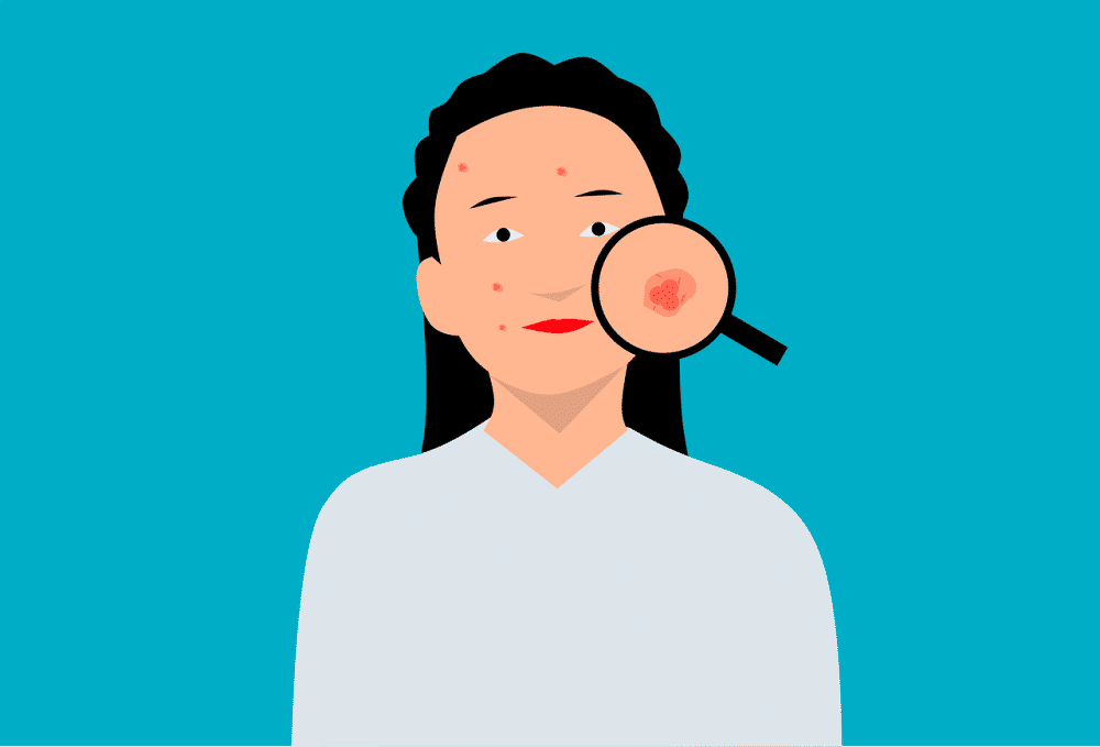 ilustrasi orang berjerawat (Pixabay.com/mohamed_hassan)