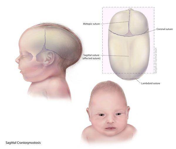 ilustrasi craniosynostosis atau kraniosinostosis jenis sagital (cdc.gov)