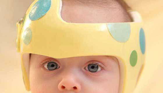 ilustrasi helm sebagai terapi craniosynostosis pada bayi (hopkinsmedicine.org)
